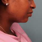 Submental Liposuction Before & After Patient #4789