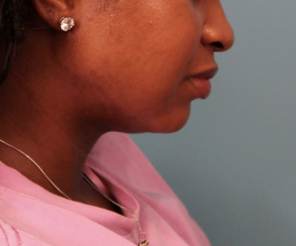 Submental Liposuction Before & After Patient #4789