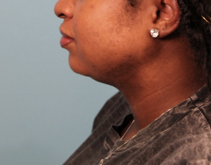 Submental Liposuction Before & After Patient #4789