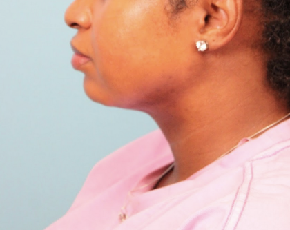 Submental Liposuction Before & After Patient #4789