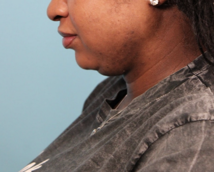 Submental Liposuction Before & After Patient #4789