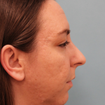 Chin Implant Before & After Patient #4959