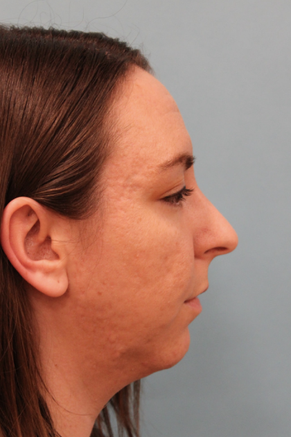 Rhinoplasty Before & After Patient #4958