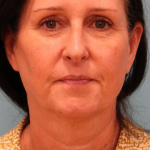 Facelift Before & After Patient #4957