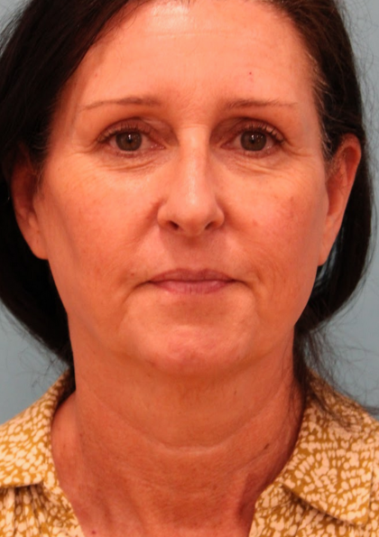 Facelift Before & After Patient #4957