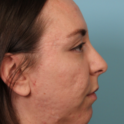 Chin Implant Before & After Patient #4959