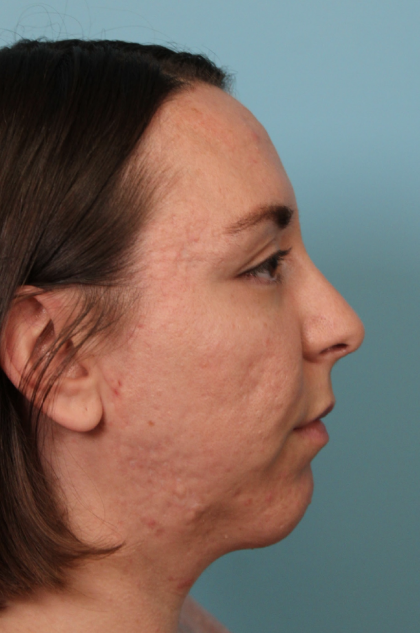 Rhinoplasty Before & After Patient #4958
