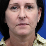 Facelift Before & After Patient #4957