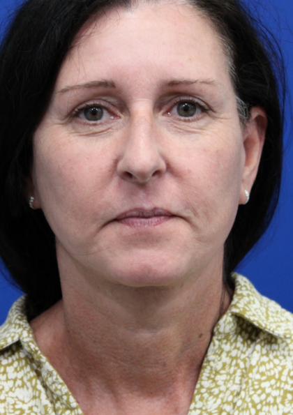 Facelift Before & After Patient #4957