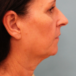 Facelift Before & After Patient #4957