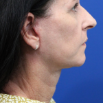Facelift Before & After Patient #4957