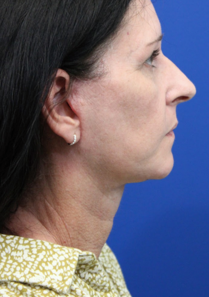 Facelift Before & After Patient #4957