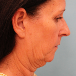 Facelift Before & After Patient #4957