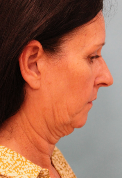 Facelift Before & After Patient #4957
