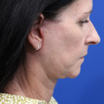 Facelift Before & After Patient #4957