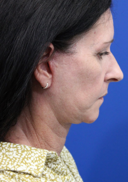Facelift Before & After Patient #4957
