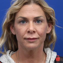 Deep Neck Lift Before & After Patient #5006