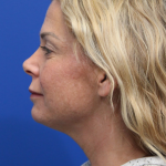Deep Neck Lift Before & After Patient #5006