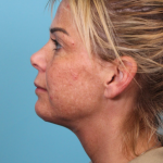 Deep Neck Lift Before & After Patient #5006