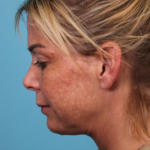 Deep Neck Lift Before & After Patient #5006