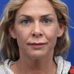 Deep Neck Lift Before & After Patient #5006