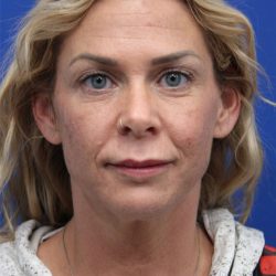 Deep Neck Lift Before & After Patient #5006