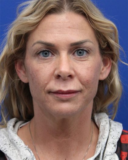 Deep Neck Lift Before & After Patient #5006