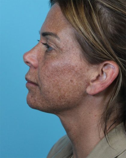 Deep Neck Lift Before & After Patient #5006