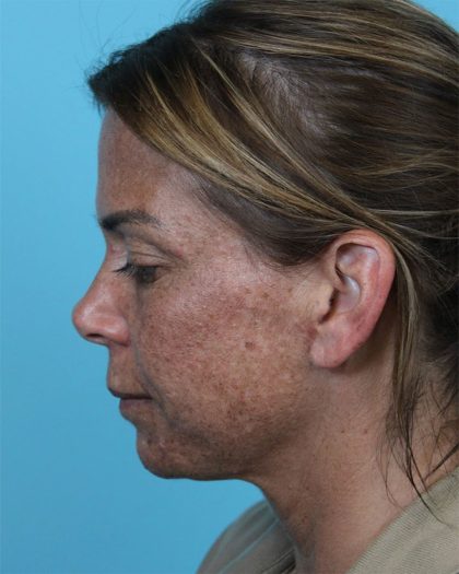 Deep Neck Lift Before & After Patient #5006