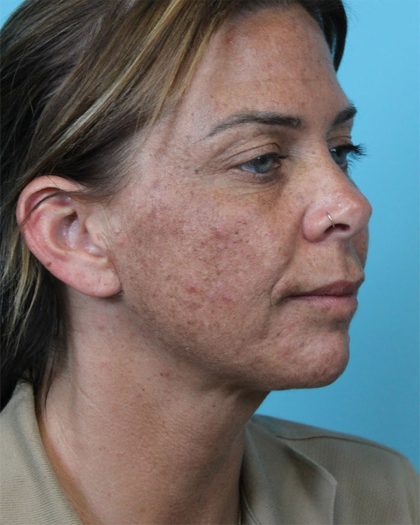 Deep Neck Lift Before & After Patient #5006