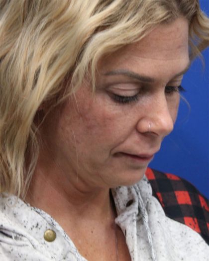Deep Neck Lift Before & After Patient #5006