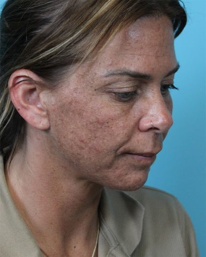 Deep Neck Lift Before & After Patient #5006