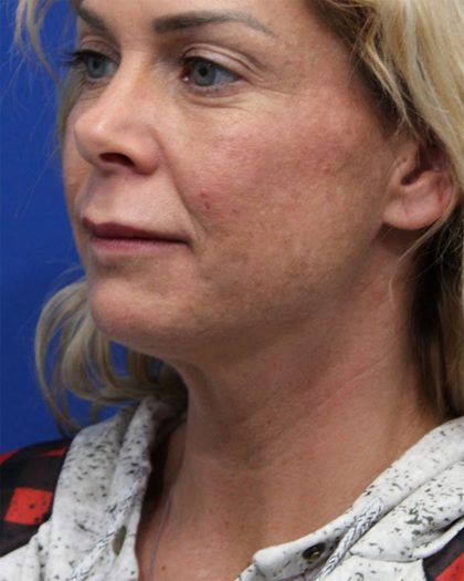 Deep Neck Lift Before & After Patient #5006