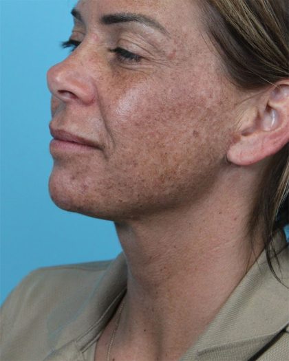 Deep Neck Lift Before & After Patient #5006