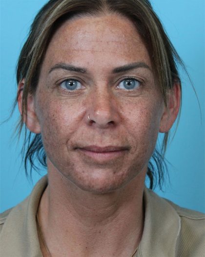 Deep Neck Lift Before & After Patient #5006