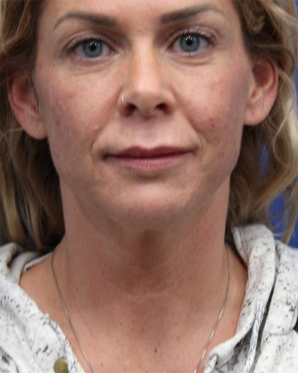 Deep Neck Lift Before & After Patient #5006
