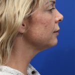 Deep Neck Lift Before & After Patient #5006