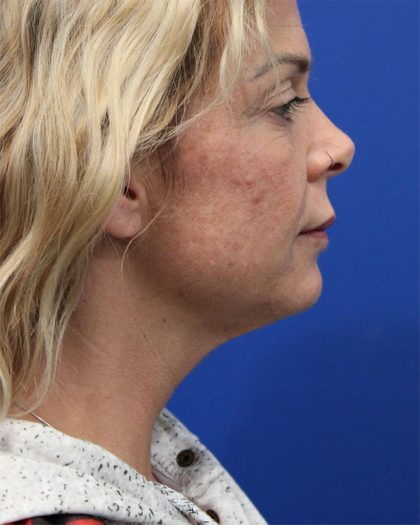 Deep Neck Lift Before & After Patient #5006