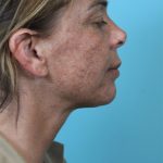 Deep Neck Lift Before & After Patient #5006