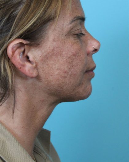 Deep Neck Lift Before & After Patient #5006