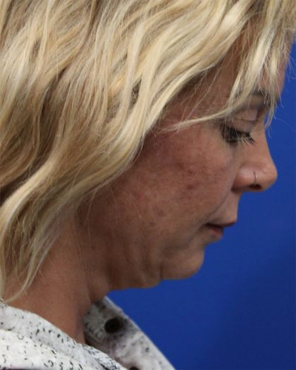 Deep Neck Lift Before & After Patient #5006