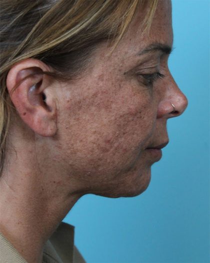 Deep Neck Lift Before & After Patient #5006