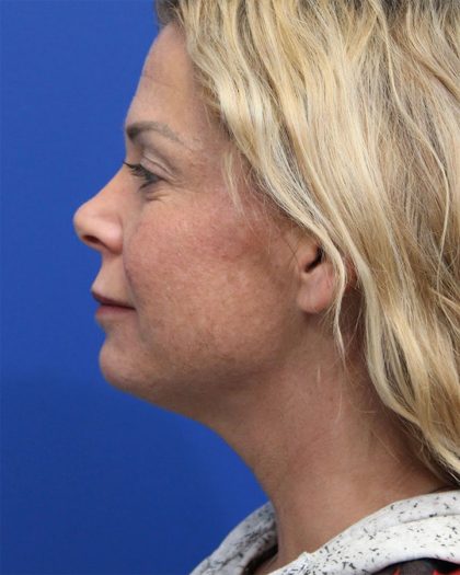 Deep Neck Lift Before & After Patient #5006