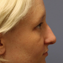 Revision Rhinoplasty Before & After Patient #5028