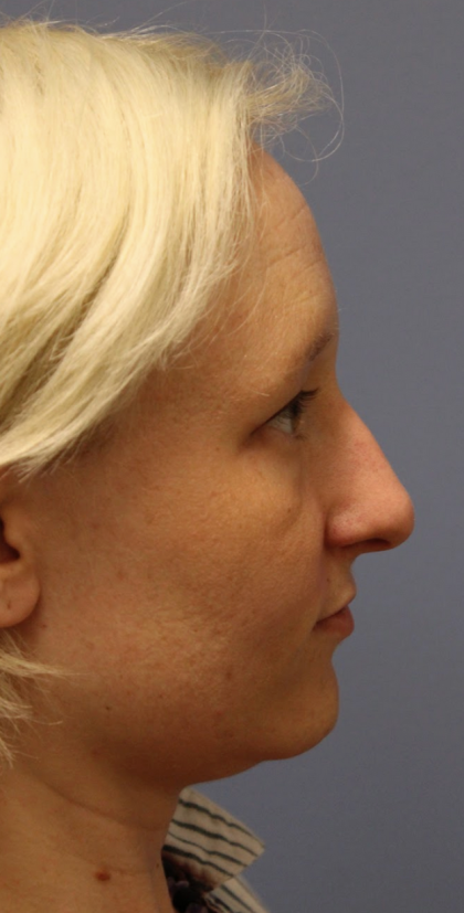 Revision Rhinoplasty Before & After Patient #5028