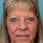 Upper Blepharoplasty Before & After Patient #5052