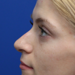 Revision Rhinoplasty Before & After Patient #5029