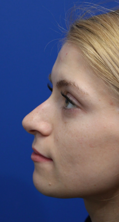 Revision Rhinoplasty Before & After Patient #5029