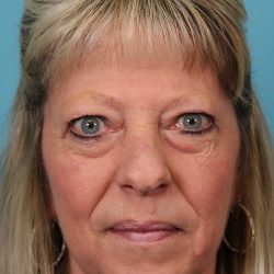 Upper Blepharoplasty Before & After Patient #5052
