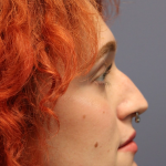 Rhinoplasty Before & After Patient #5053